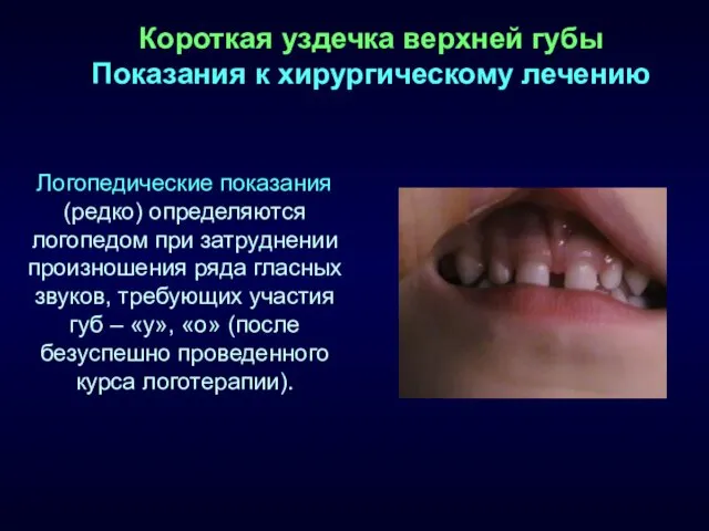 Короткая уздечка верхней губы Показания к хирургическому лечению Логопедические показания