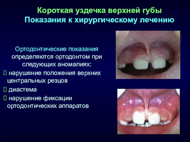 Короткая уздечка верхней губы Показания к хирургическому лечению Ортодонтические показания