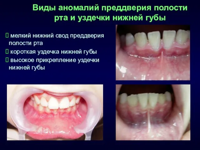 Виды аномалий преддверия полости рта и уздечки нижней губы мелкий