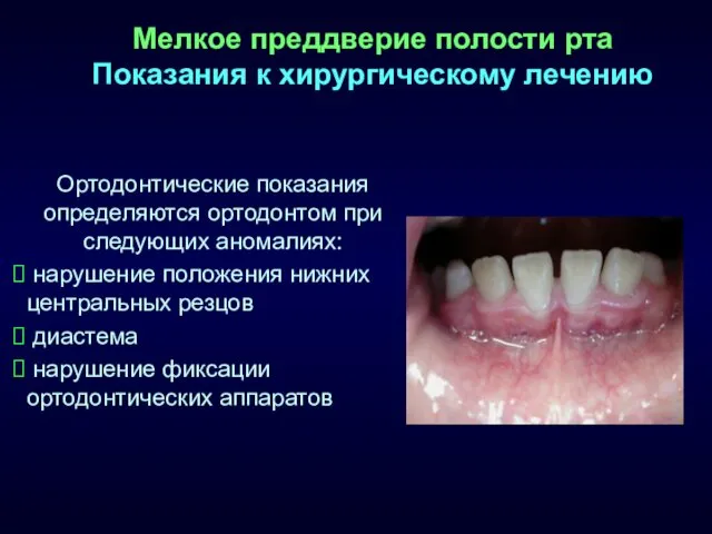 Мелкое преддверие полости рта Показания к хирургическому лечению Ортодонтические показания