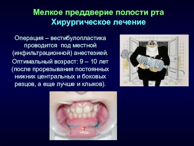 Мелкое преддверие полости рта Хирургическое лечение Операция – вестибулопластика проводится