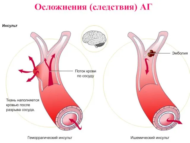 Осложнения (следствия) АГ