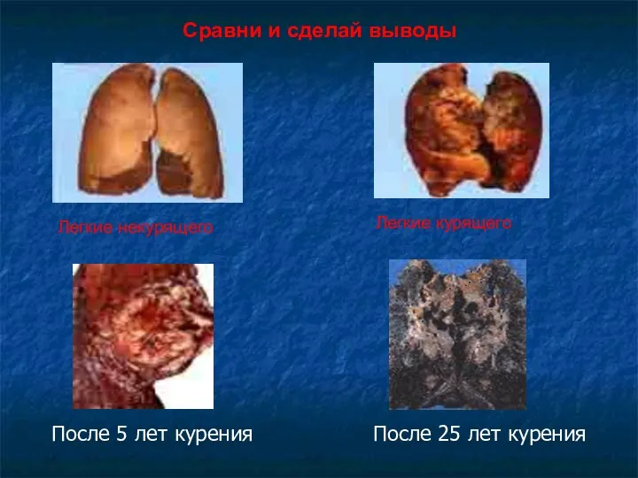 После 5 лет курения После 25 лет курения Сравни и сделай выводы Легкие некурящего Легкие курящего