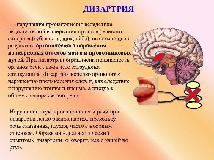 дизартрия Нарушение звукопроизношения и речи при дизартрии легко распознаются, поскольку