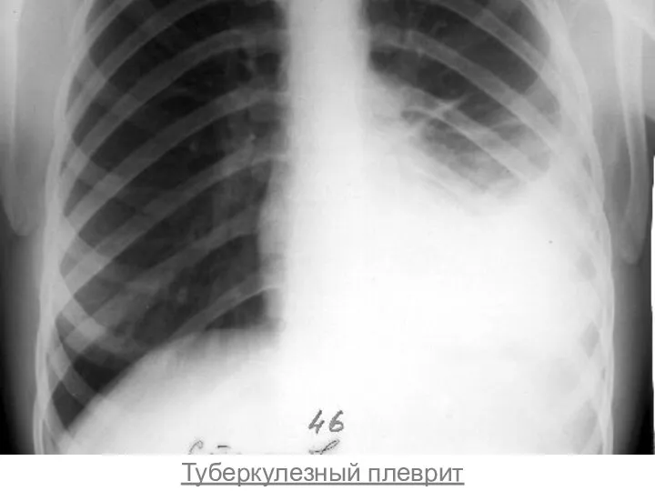 Туберкулезный плеврит