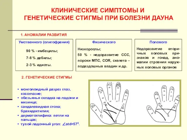 КЛИНИЧЕСКИЕ СИМПТОМЫ И ГЕНЕТИЧЕСКИЕ СТИГМЫ ПРИ БОЛЕЗНИ ДАУНА 1. АНОМАЛИИ