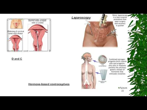 D and C Hormone-based contraceptives Laparoscopy