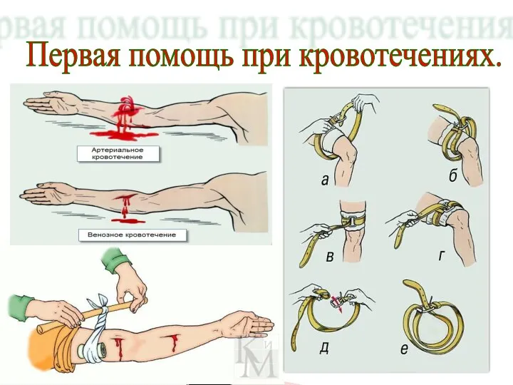 Первая помощь при кровотечениях.