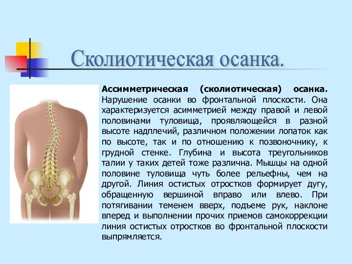 Ассимметрическая (сколиотическая) осанка. Нарушение осанки во фронтальной плоскости. Она характеризуется