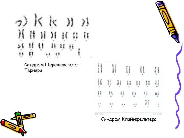 Синдром Шерешевского - Тернера Синдром Клайнфельтера