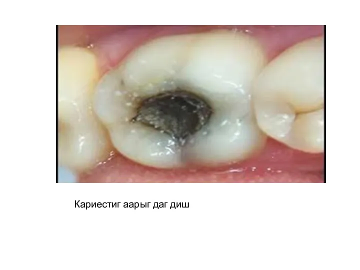 Кариестиг аарыг даг диш