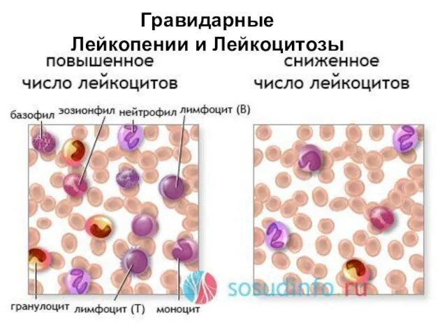 Гравидарные Лейкопении и Лейкоцитозы