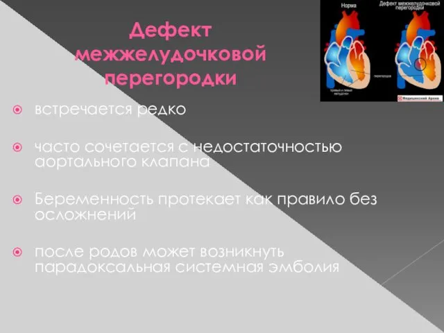 Дефект межжелудочковой перегородки встречается редко часто сочетается с недостаточностью аортального клапана Беременность протекает