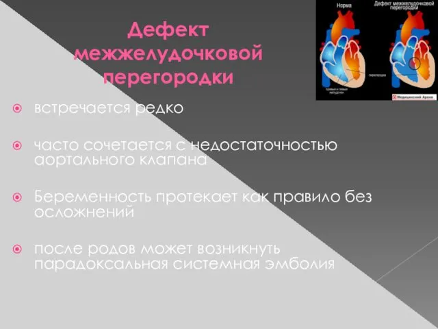 Дефект межжелудочковой перегородки встречается редко часто сочетается с недостаточностью аортального