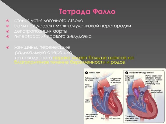 Тетрада Фалло стеноз устья легочного ствола большой дефект межжелудочковой перегородки декстропозиция аорты гипертрофия