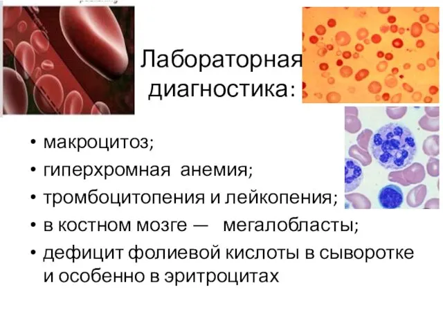 Лабораторная диагностика: макроцитоз; гиперхромная анемия; тромбоцитопения и лейкопения; в костном мозге — мегалобласты;