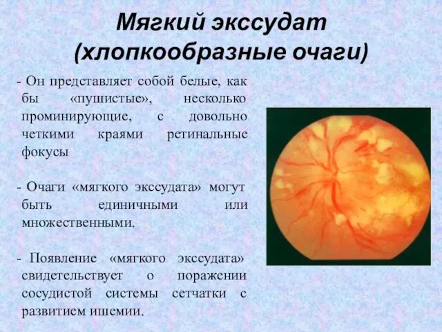 Мягкий экссудат (хлопкообразные очаги) Он представляет собой белые, как бы