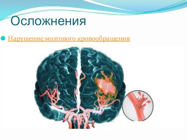 Осложнения Нарушение мозгового кровообращения