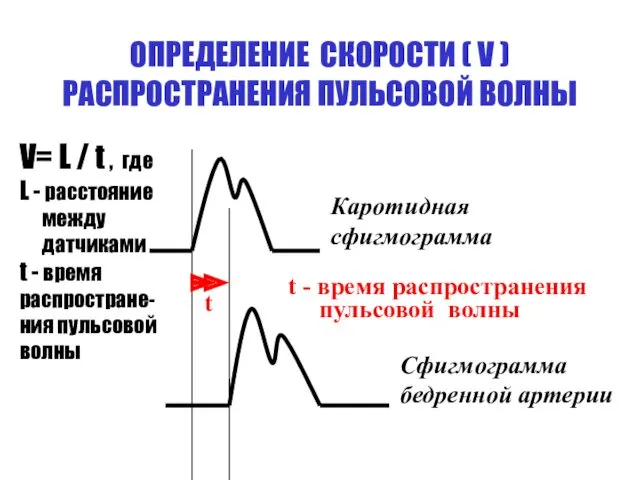 ОПРЕДЕЛЕНИЕ СКОРОСТИ ( V ) РАСПРОСТРАНЕНИЯ ПУЛЬСОВОЙ ВОЛНЫ t Каротидная