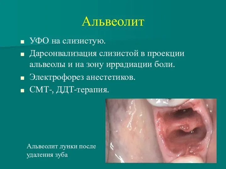 Альвеолит УФО на слизистую. Дарсонвализация слизистой в проекции альвеолы и