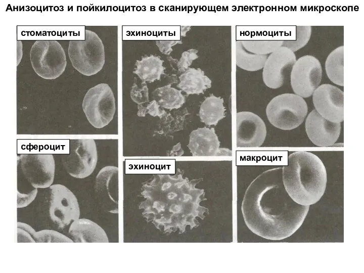 Анизоцитоз и пойкилоцитоз в сканирующем электронном микроскопе нормоциты макроцит эхиноцит стоматоциты сфероцит эхиноциты