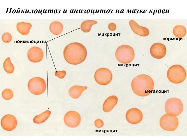 Пойкилоцитоз и анизоцитоз на мазке крови пойкилоциты микроцит нормоцит мегалоцит микроцит макроцит