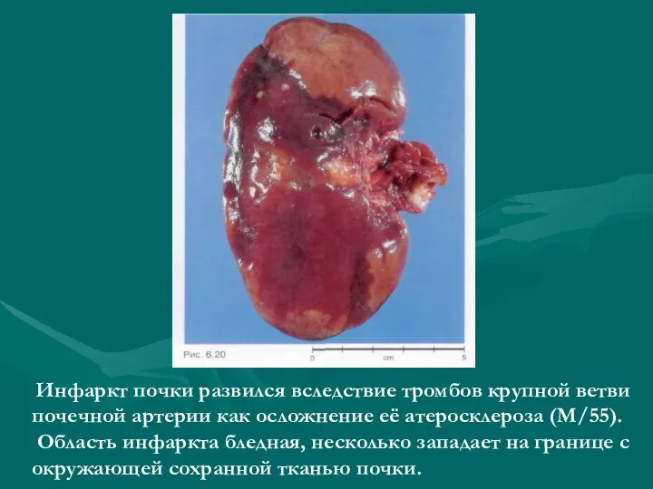 Инфаркт почки развился вследствие тромбов крупной ветви почечной артерии как осложнение её атеросклероза