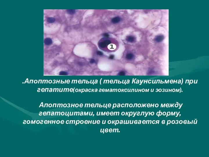 .Апоптозные тельца ( тельца Каунсильмена) при гепатите(окраска гематоксилином и эозином). Апоптозное тельце расположено