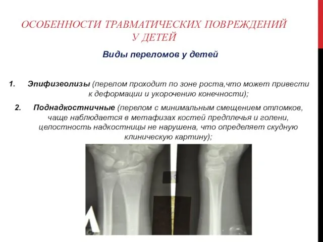 ОСОБЕННОСТИ ТРАВМАТИЧЕСКИХ ПОВРЕЖДЕНИЙ У ДЕТЕЙ Виды переломов у детей Эпифизеолизы