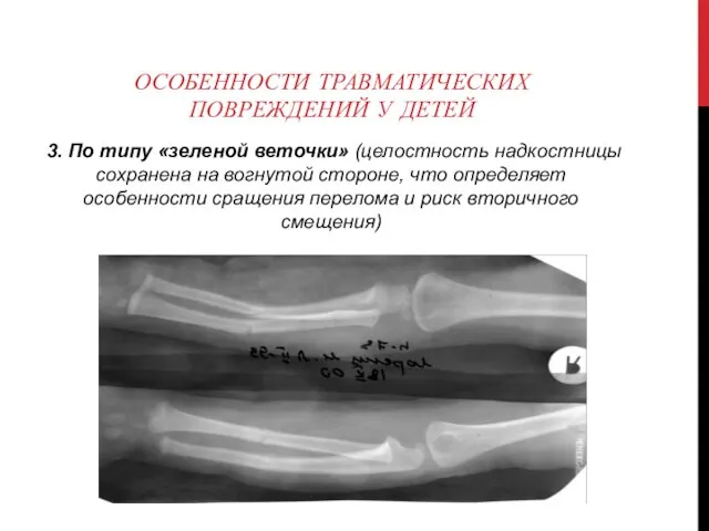 ОСОБЕННОСТИ ТРАВМАТИЧЕСКИХ ПОВРЕЖДЕНИЙ У ДЕТЕЙ 3. По типу «зеленой веточки»