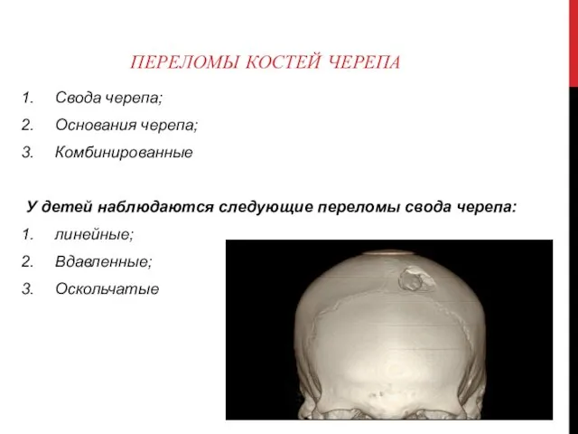 ПЕРЕЛОМЫ КОСТЕЙ ЧЕРЕПА Свода черепа; Основания черепа; Комбинированные У детей