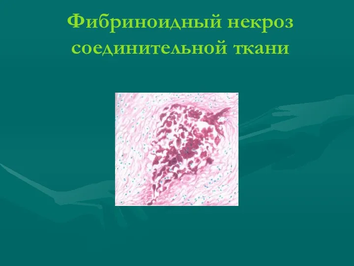 Фибриноидный некроз соединительной ткани