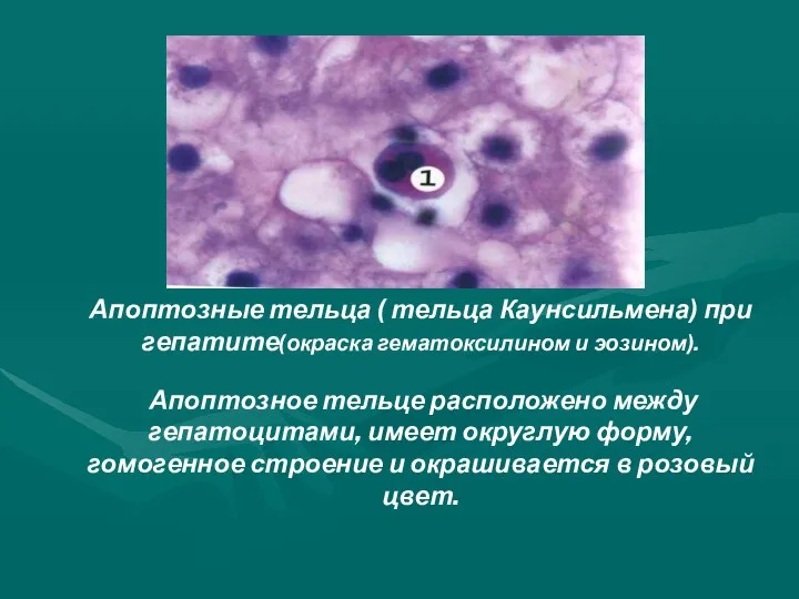 Апоптозные тельца ( тельца Каунсильмена) при гепатите(окраска гематоксилином и эозином).
