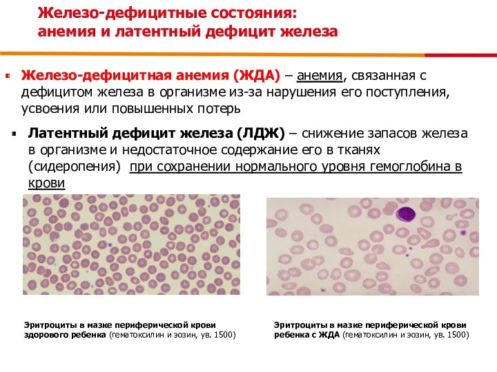 Железо-дефицитные состояния: анемия и латентный дефицит железа Железо-дефицитная анемия (ЖДА)