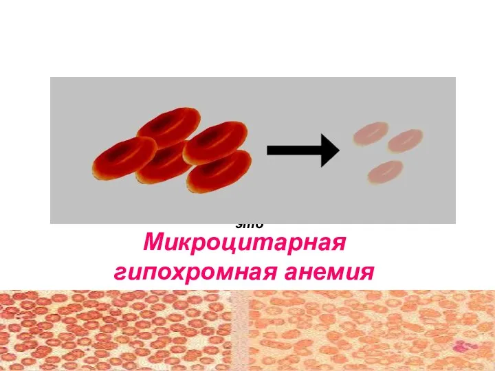 Железодефицитная анемия Микроцитарная гипохромная анемия это