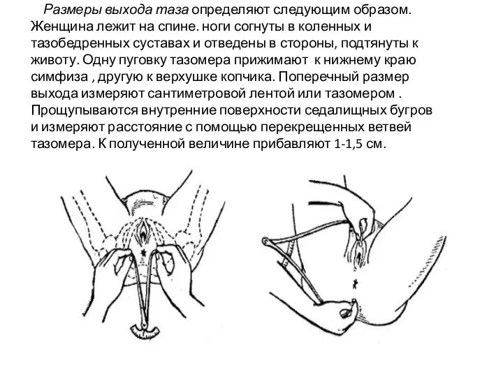 Размеры выхода таза определяют следующим образом. Женщина лежит на спине.