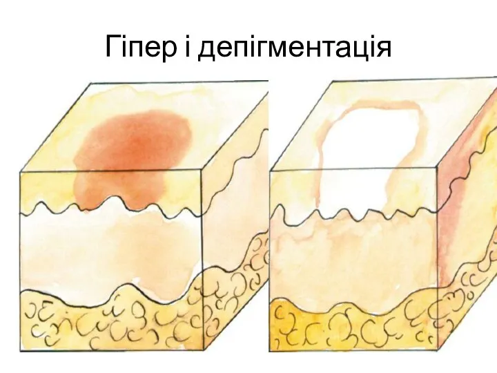 Гіпер і депігментація