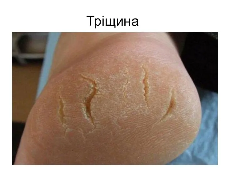 Тріщина