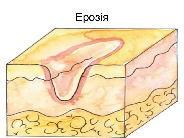 Ерозія