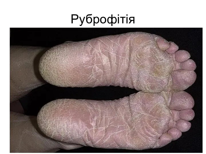 Руброфітія