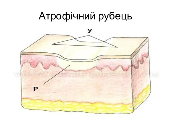 Атрофічний рубець