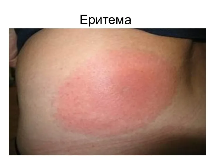 Еритема