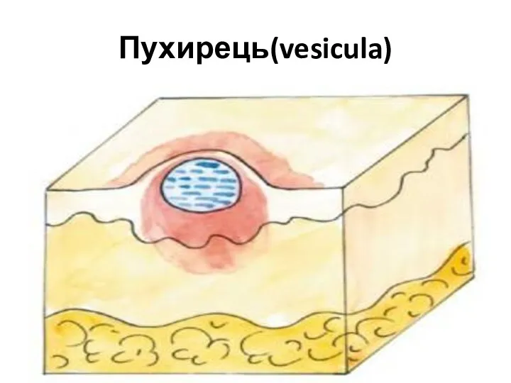 Пухирець(vesicula)