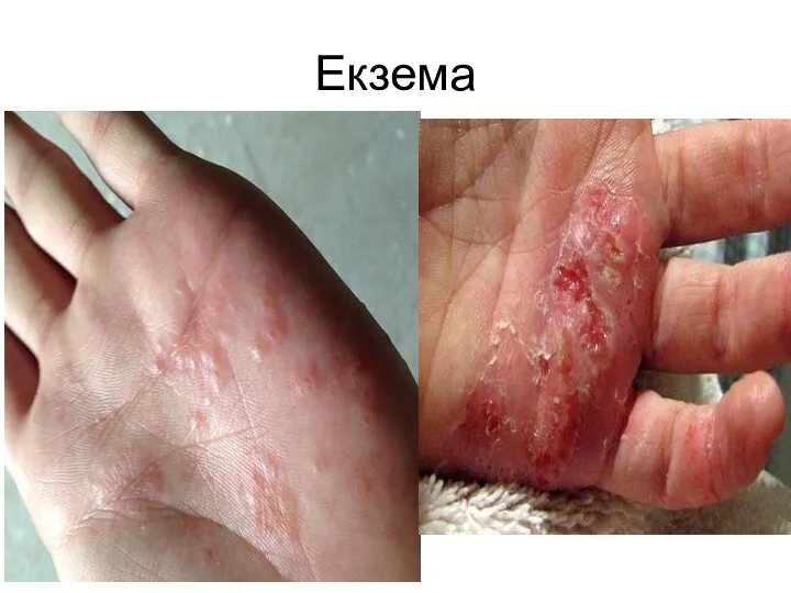 Екзема