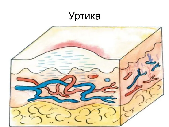 Уртика