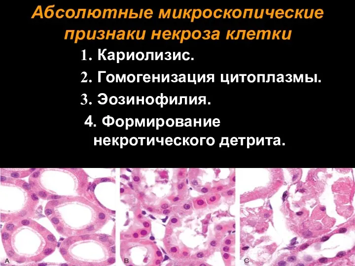 Абсолютные микроскопические признаки некроза клетки Кариолизис. Гомогенизация цитоплазмы. Эозинофилия. 4. Формирование некротического детрита.