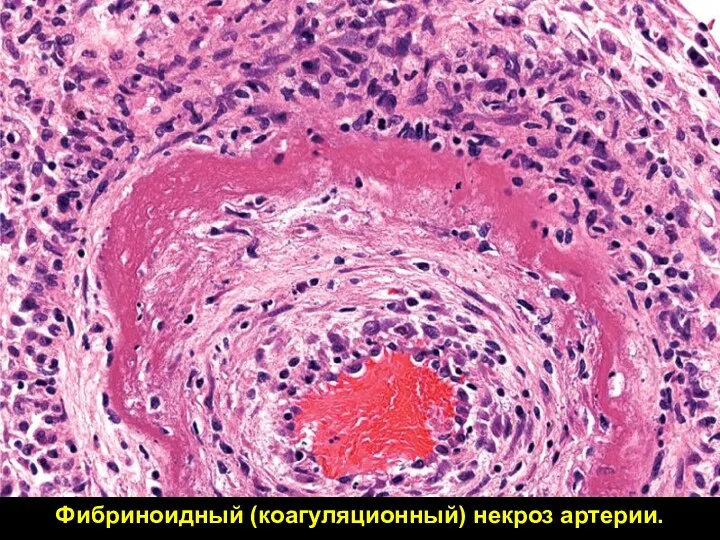 Фибриноидный (коагуляционный) некроз артерии.