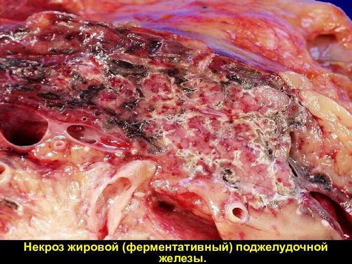 Некроз жировой (ферментативный) поджелудочной железы.