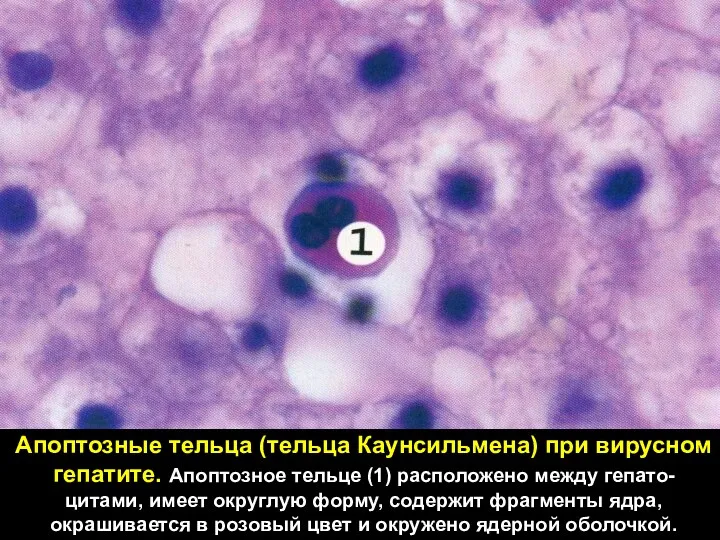Апоптозные тельца (тельца Каунсильмена) при вирусном гепатите. Апоптозное тельце (1) расположено между гепато-