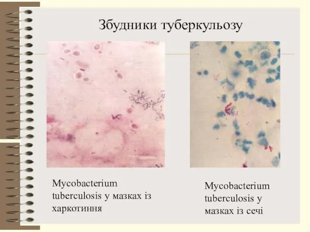 Mycobacterium tuberculosis у мазках із харкотиння Збудники туберкульозу Mycobacterium tuberculosis у мазках із сечі